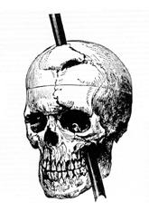 Phineas Gage's skull damaged